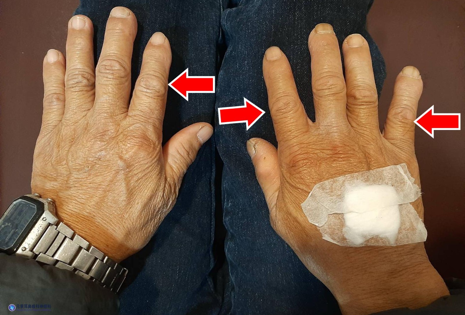 類風濕性關節炎伴生性耳鳴症候群 圖一.jpg